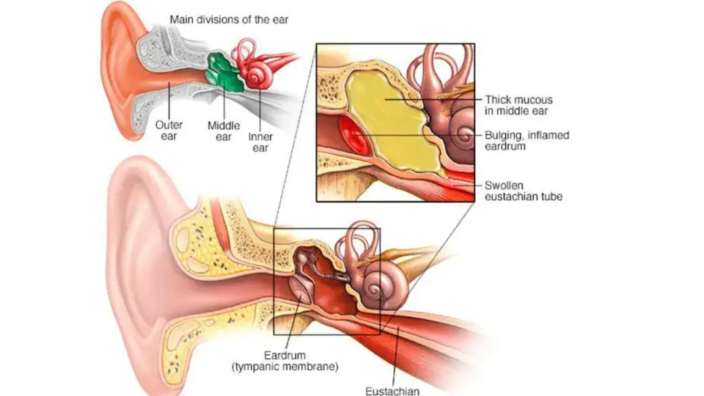 ear infection explained by diagram 